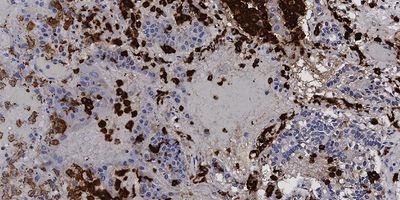 Unusually high numbers of macrophages (in brown) were detected in cross-sections of lungs from COVID-19 patients using immunohistochemical techniques. Blue counterstain detects nuclei of all cells in the cross-section.