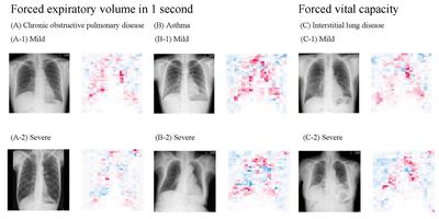 The AI model developed estimated lung function by observing the radiographs, with lower values denoted by blue areas and higher values by red areas in the saliency maps.