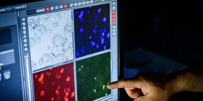 a man's hand points at a computer screen showing fluorescence microscopy images of cancer cells